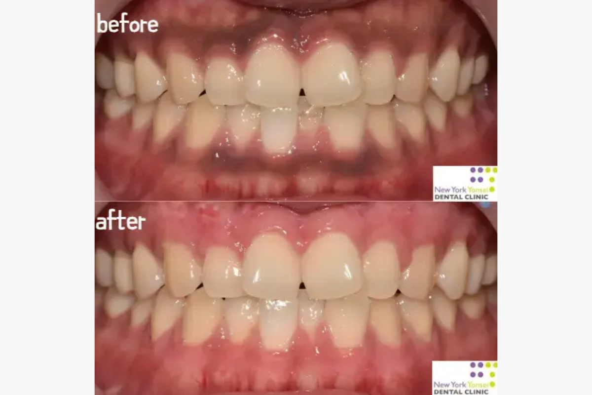 牙齒微笑線 微笑線 牙科 牙科診所 箍牙 門牙貼片 瓷牙貼片 牙齒美白 漂牙 牙齦美白 嘴唇重置術 牙齦微整形 韓國牙科 韓國牙科診所推薦 價錢