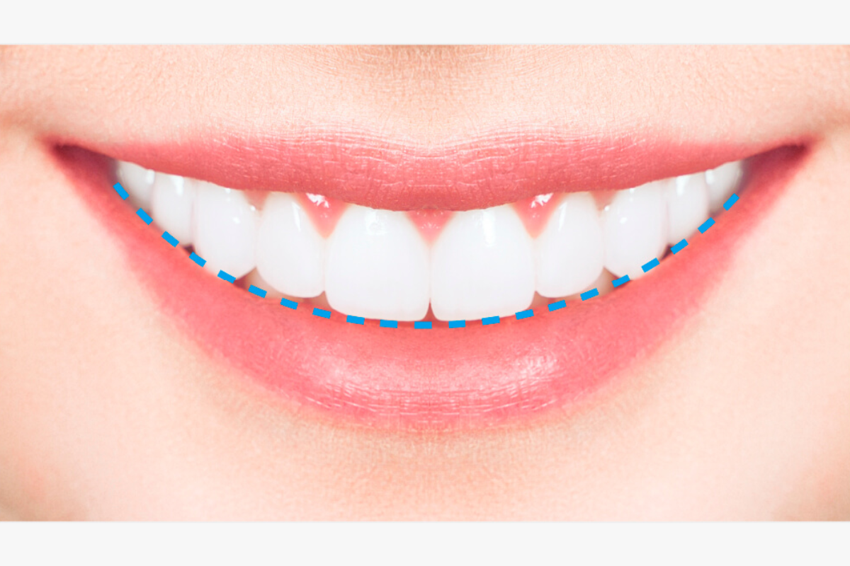 牙齒微笑線 微笑線 牙科 牙科診所 箍牙 門牙貼片 瓷牙貼片 牙齒美白 漂牙 牙齦美白 嘴唇重置術 牙齦微整形 韓國牙科 韓國牙科診所推薦 價錢