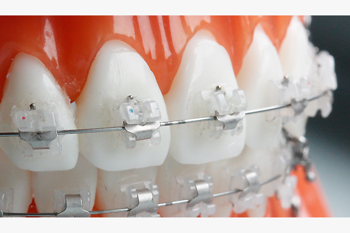 牙齒微笑線 微笑線 牙科 牙科診所 箍牙 門牙貼片 瓷牙貼片 牙齒美白 漂牙 牙齦美白 嘴唇重置術 牙齦微整形 韓國牙科 韓國牙科診所推薦 價錢