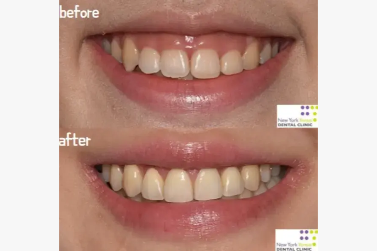 牙齒微笑線 微笑線 牙科 牙科診所 箍牙 門牙貼片 瓷牙貼片 牙齒美白 漂牙 牙齦美白 嘴唇重置術 牙齦微整形 韓國牙科 韓國牙科診所推薦 價錢