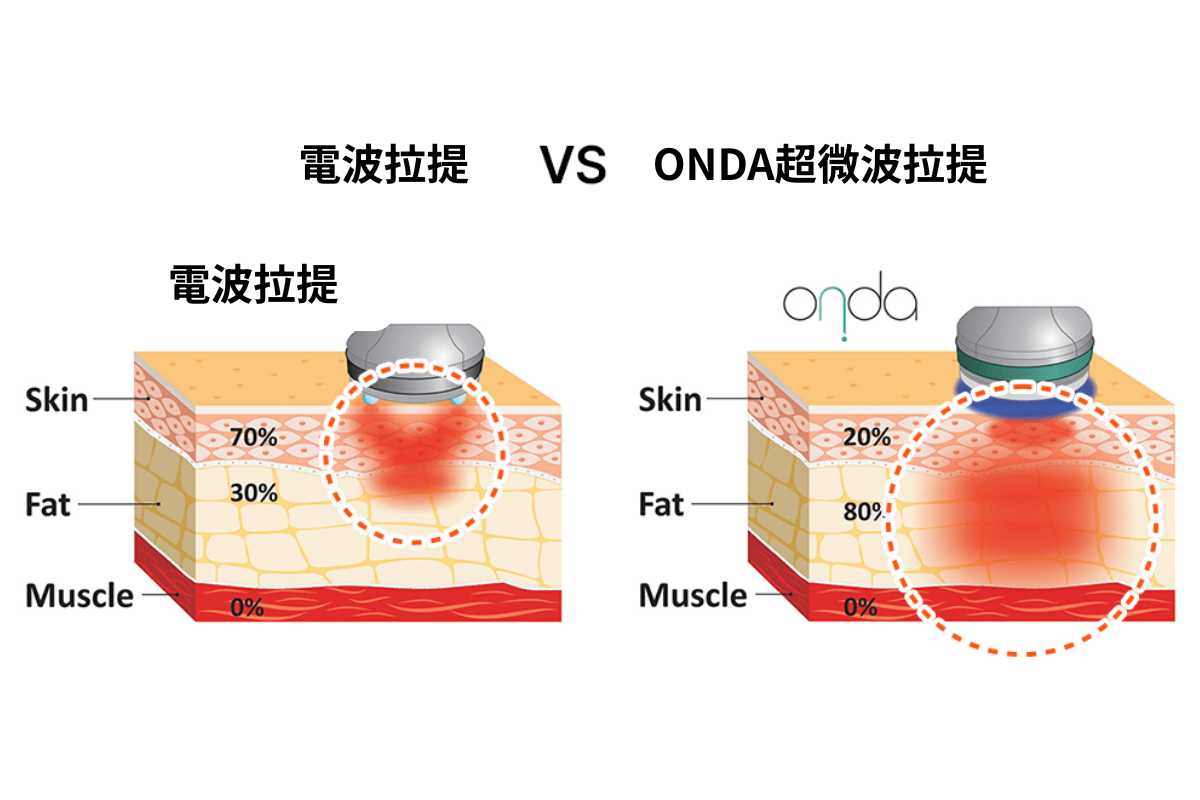 ONDA 價位 效果與比較 韓國ONDA資訊 推薦
