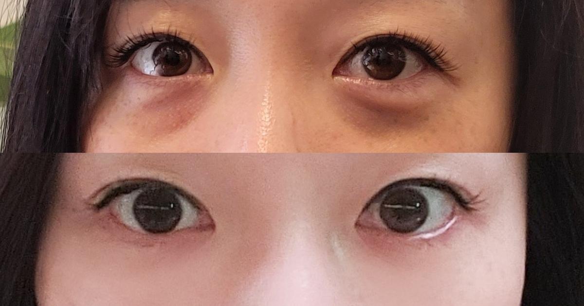 FRESH DR.HONG CLINIC | Under-Eye Fat Grafting & Liposuction Specialist