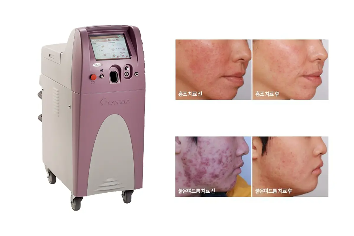 Vbeam Laser machine used for treating vascular skin conditions like red spots or acne scars.