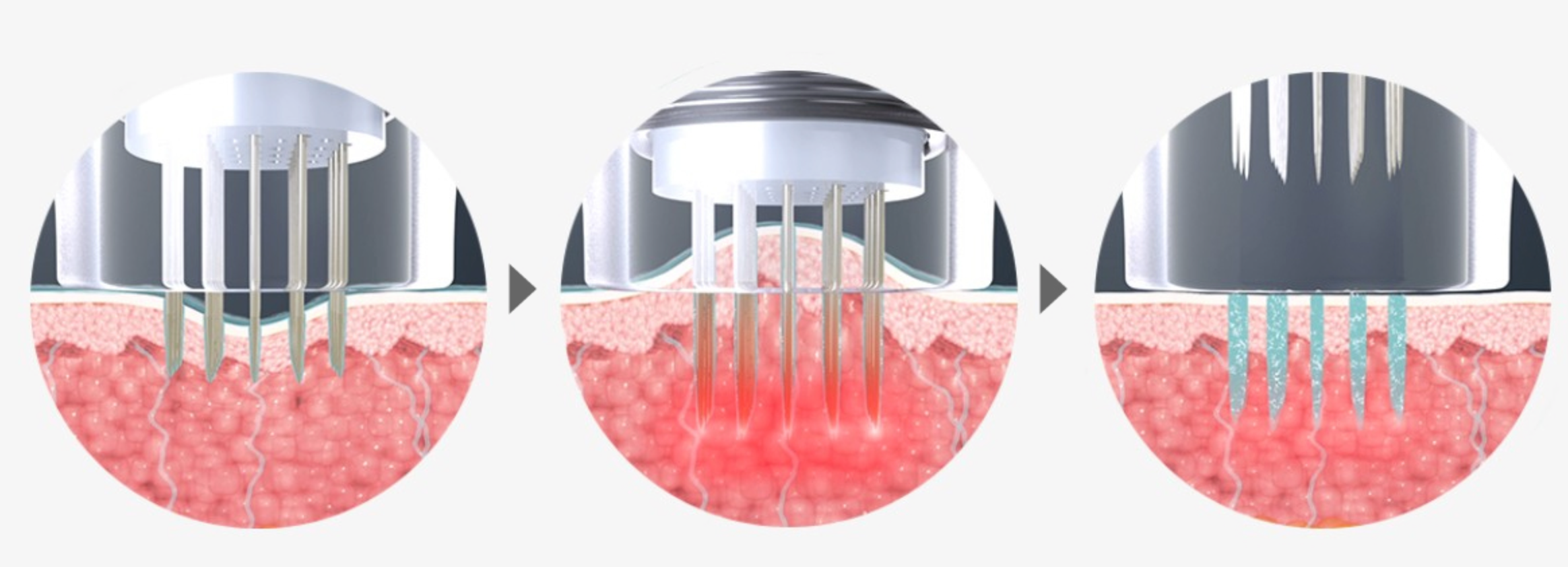 韓國 黃金微針 Potenza 療效 價錢