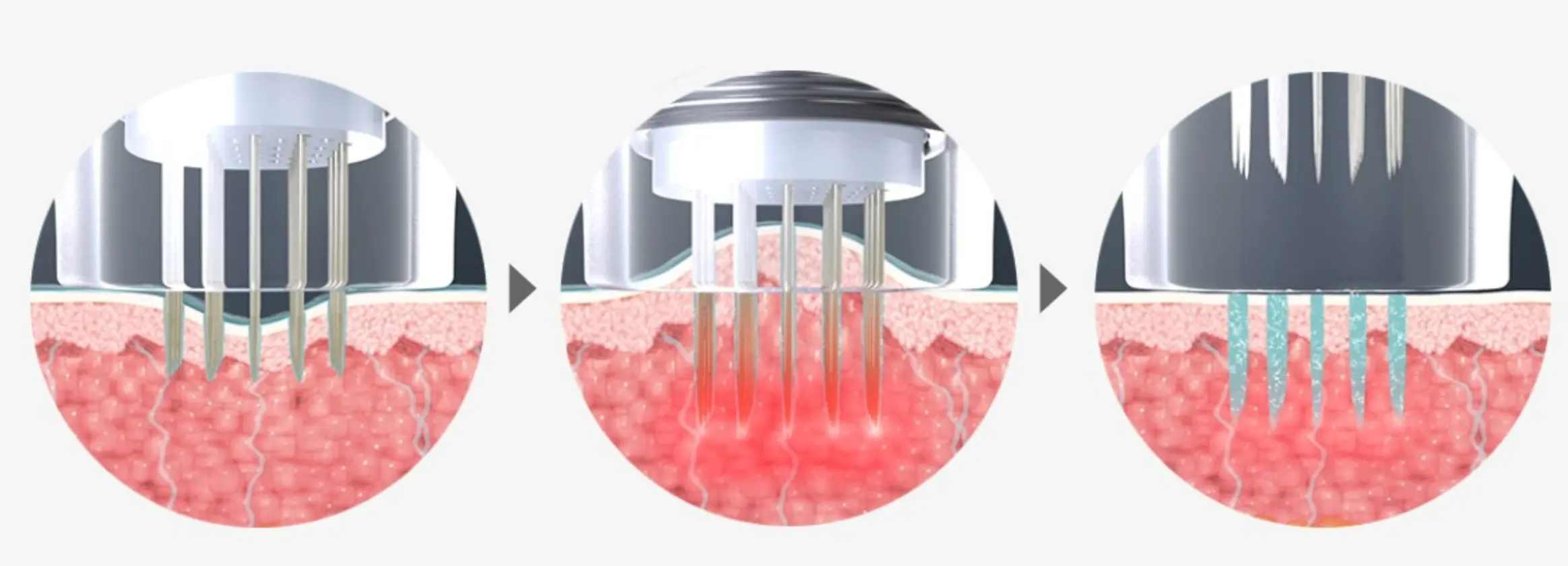 potenza黃金微針 黃金微針 毛孔 凹凸洞 暗瘡 韓國醫美 韓國醫美療程 potenza效果 黃金微針效果 暗瘡印 無創煥膚 potenza探頭類型 醫美診所推薦