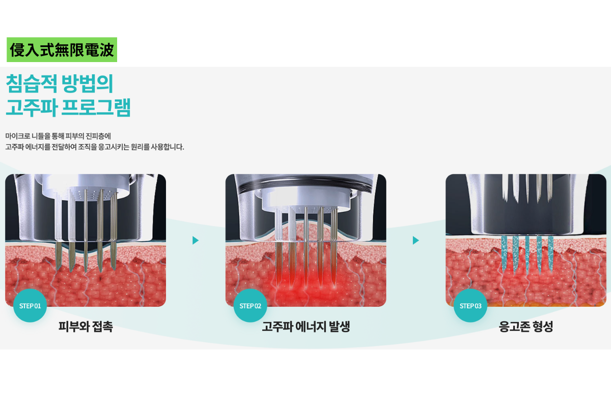 韓國 黃金微針 Potenza 療效 價錢 探頭 推薦診所