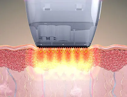 potenza黃金微針 黃金微針 毛孔 凹凸洞 暗瘡 韓國醫美 韓國醫美療程 potenza效果 黃金微針效果 暗瘡印 無創煥膚 potenza探頭類型 醫美診所推薦