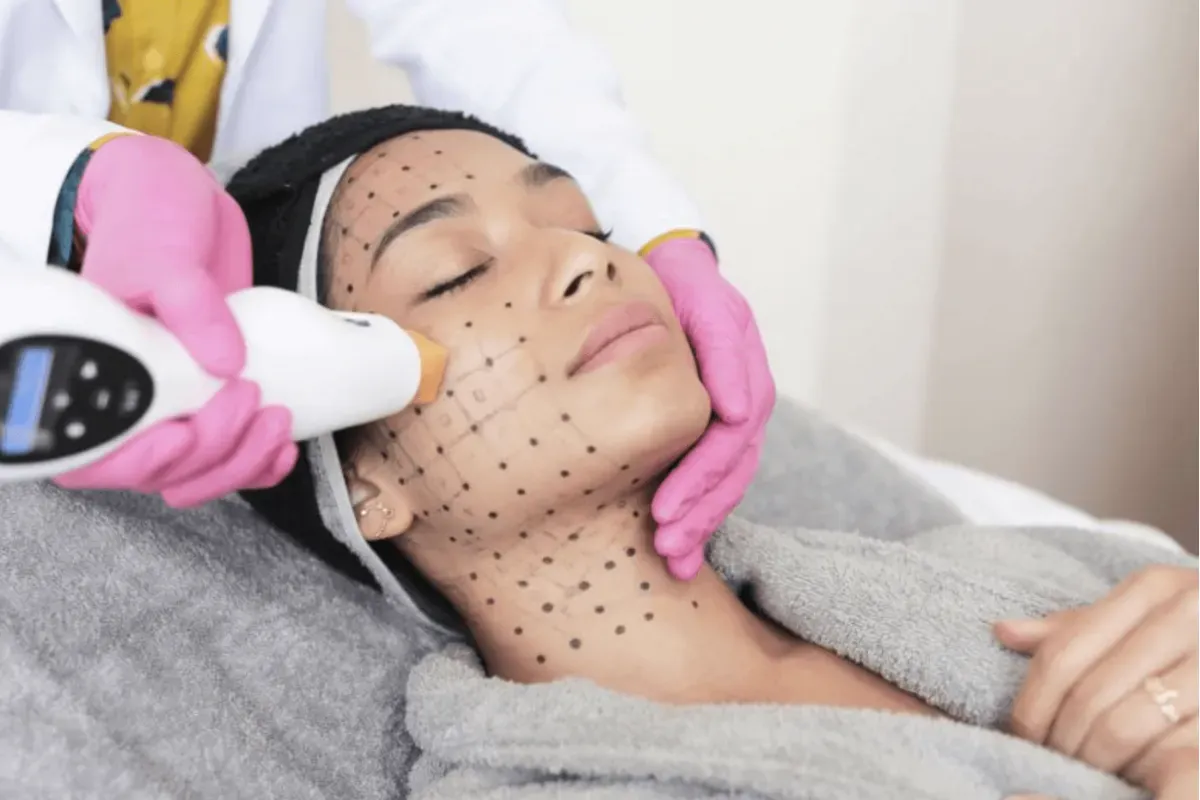 韓國鳳凰電波 價格 價差 美版電波 熱瑪吉效果 韓國醫美