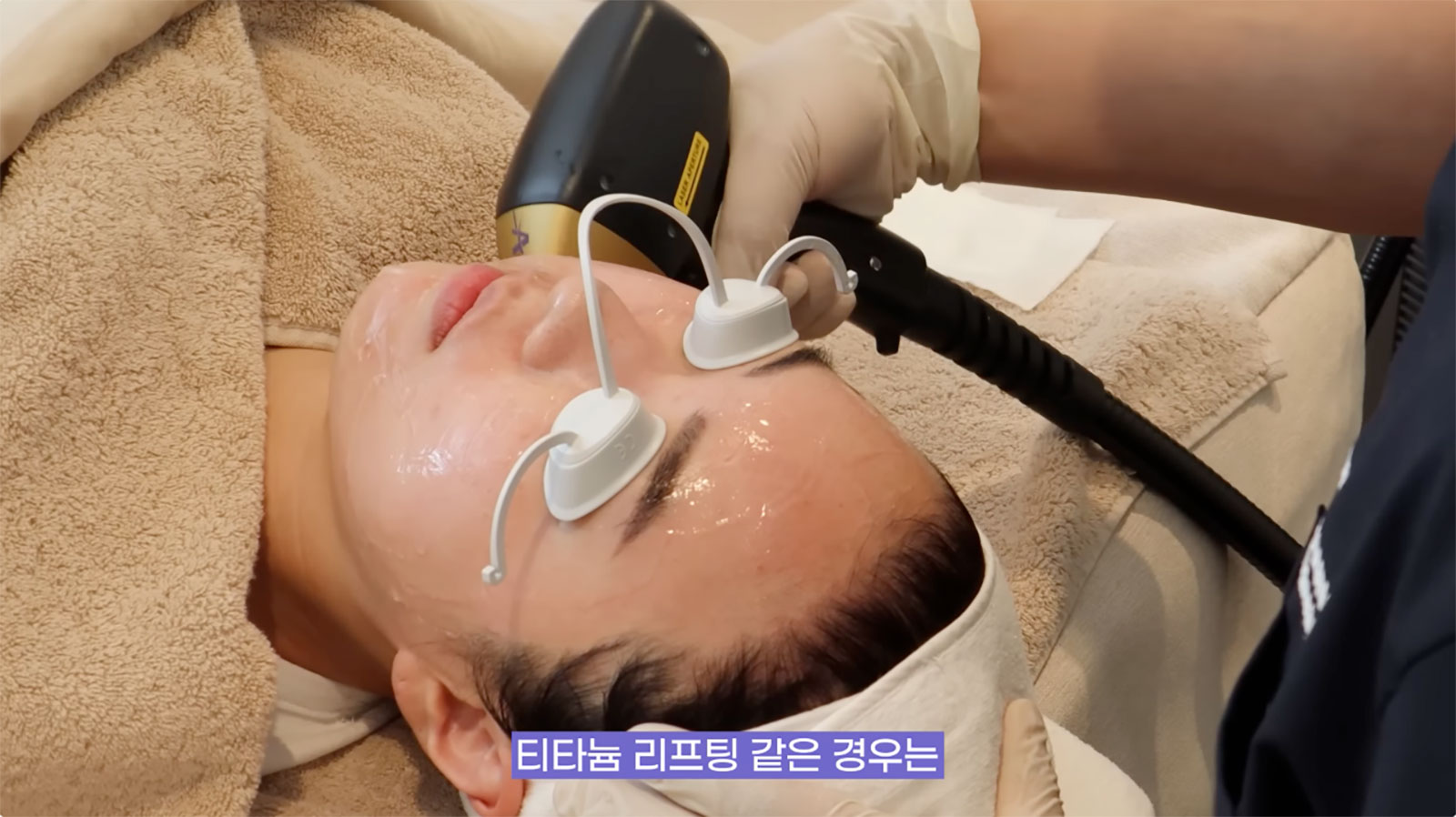 韓國 鈦提升 效果 真實評價 療效 鈦提升維持多久 韓國醫美 推薦