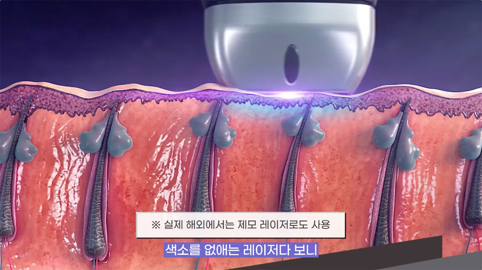 韓國 鈦提升 效果 真實評價 療效 鈦提升維持多久 韓國醫美 推薦