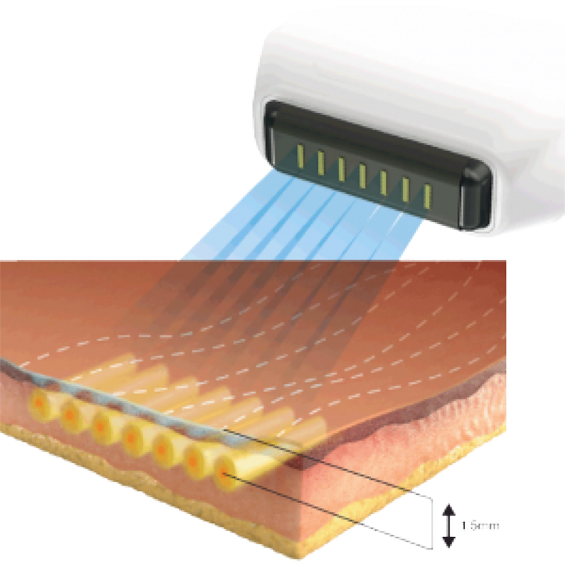 Sofwave 索夫波 韓國醫美 療程 拉提 索夫波價格 韓國便宜