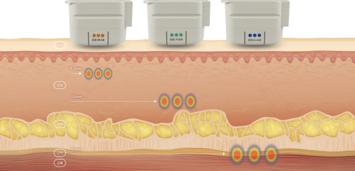 韓國打Ulthera 美版音波拉提 極線音波 韓國