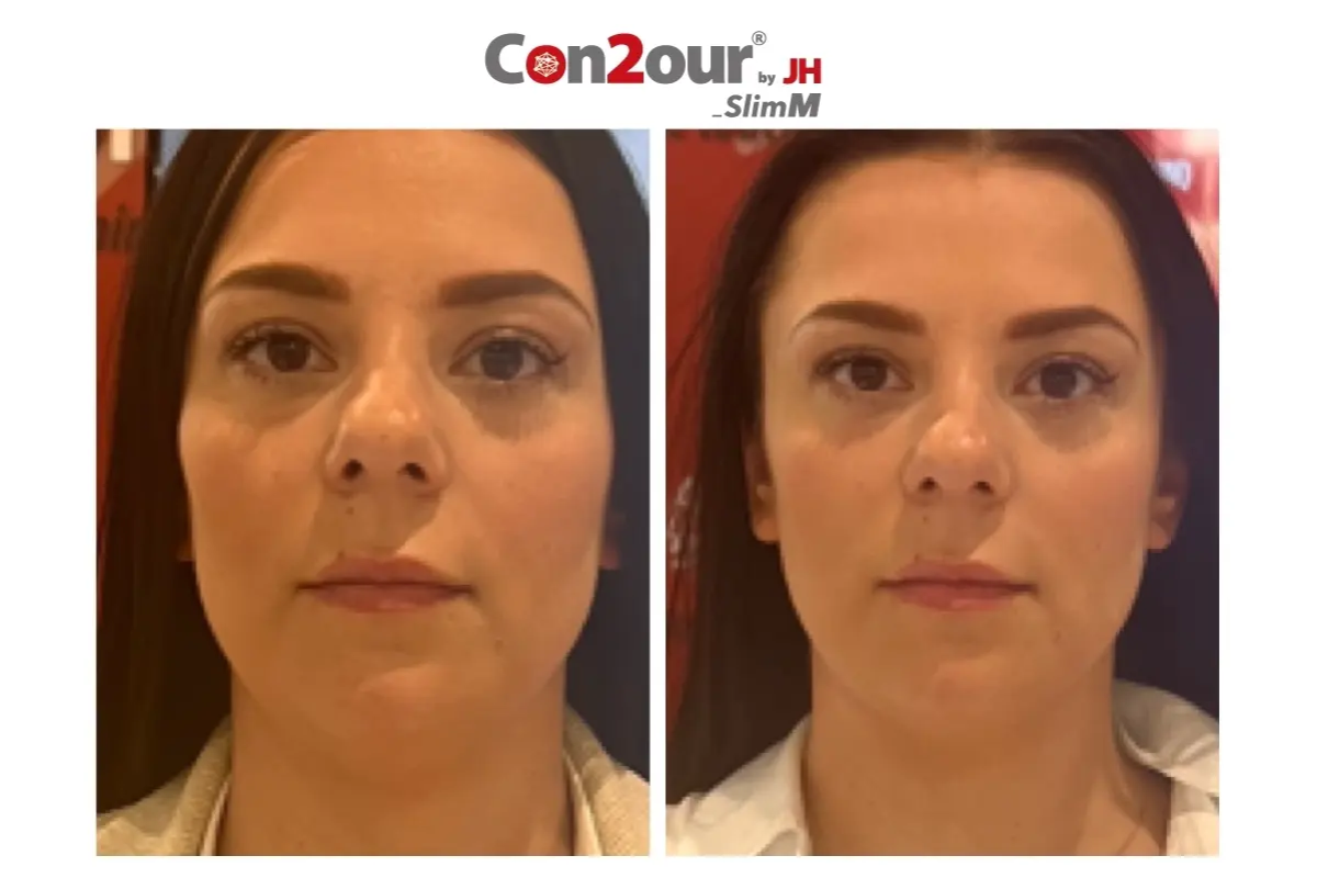 韓國醫美 V面瘦面 小顏提拉 消腫飲品 經絡瘦面 淋巴排毒 家用美容儀 醫美療程 瘦臉 V臉 韓妹 韓國文化 韓國美容