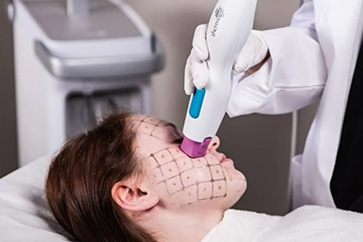 HIFU超聲刀 電波拉提 超聲刀療程 電波拉皮 緊緻拉提 抗老療程 面部提升 醫美診所推薦 韓國醫美 韓國醫美攻略 熱瑪吉 Ultherapy Thermage Shurink Oligio Volnewmer Liftera V面 緊緻