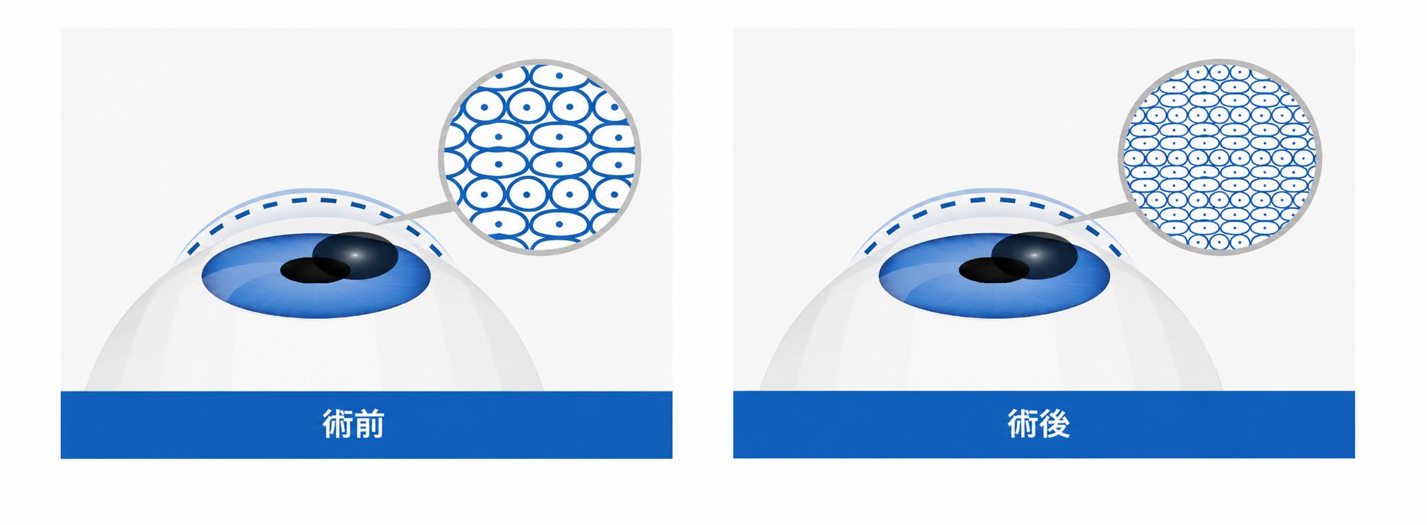 角膜強化術示意圖，顯示術後角膜結構更緊密穩固