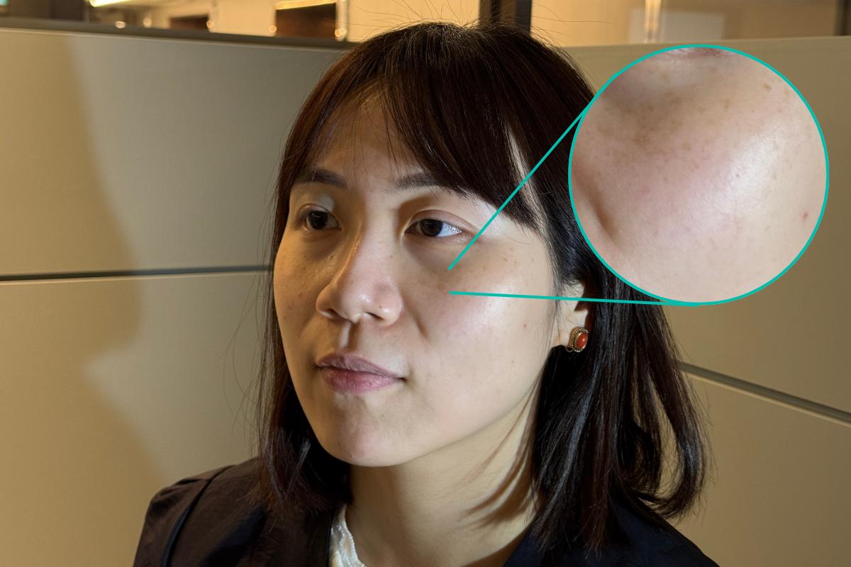 韓國皮膚科專科醫生 韓國皮膚科 韓國醫美 醫美療程真實體驗後記