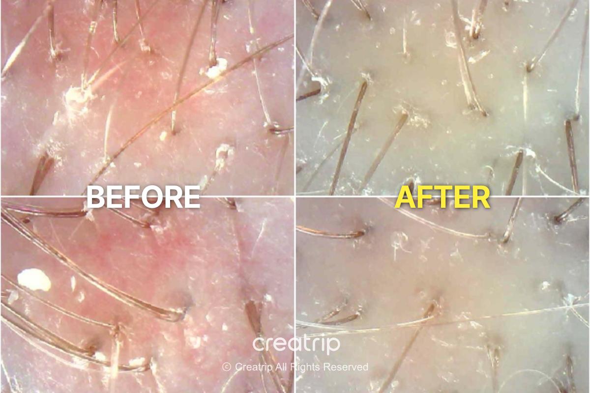 Before-and-after scalp imaging from the same head spa session