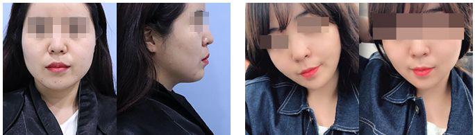 Apgujeong WOOA Plastic Surgery Clinic