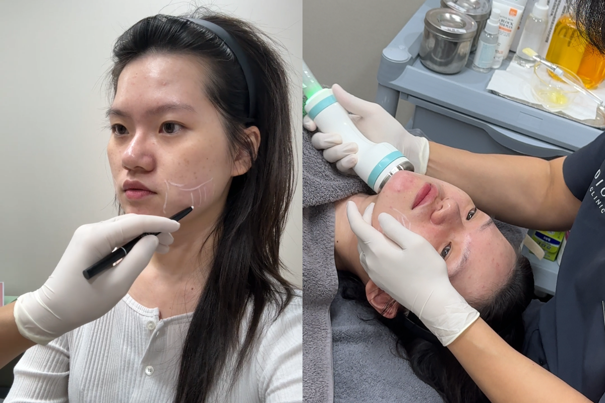DIORE CLINIC treatment ONDA Gangnam cosmetic clinic Gangnam cosmetic clinic introduction Gangnam dermatology