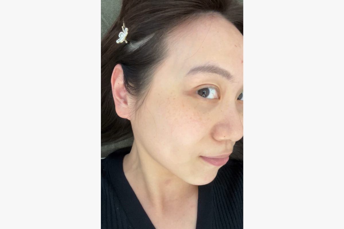 LE SHINE CLINIC treatment experience Gangnam aesthetic clinic Gangnam dermatology