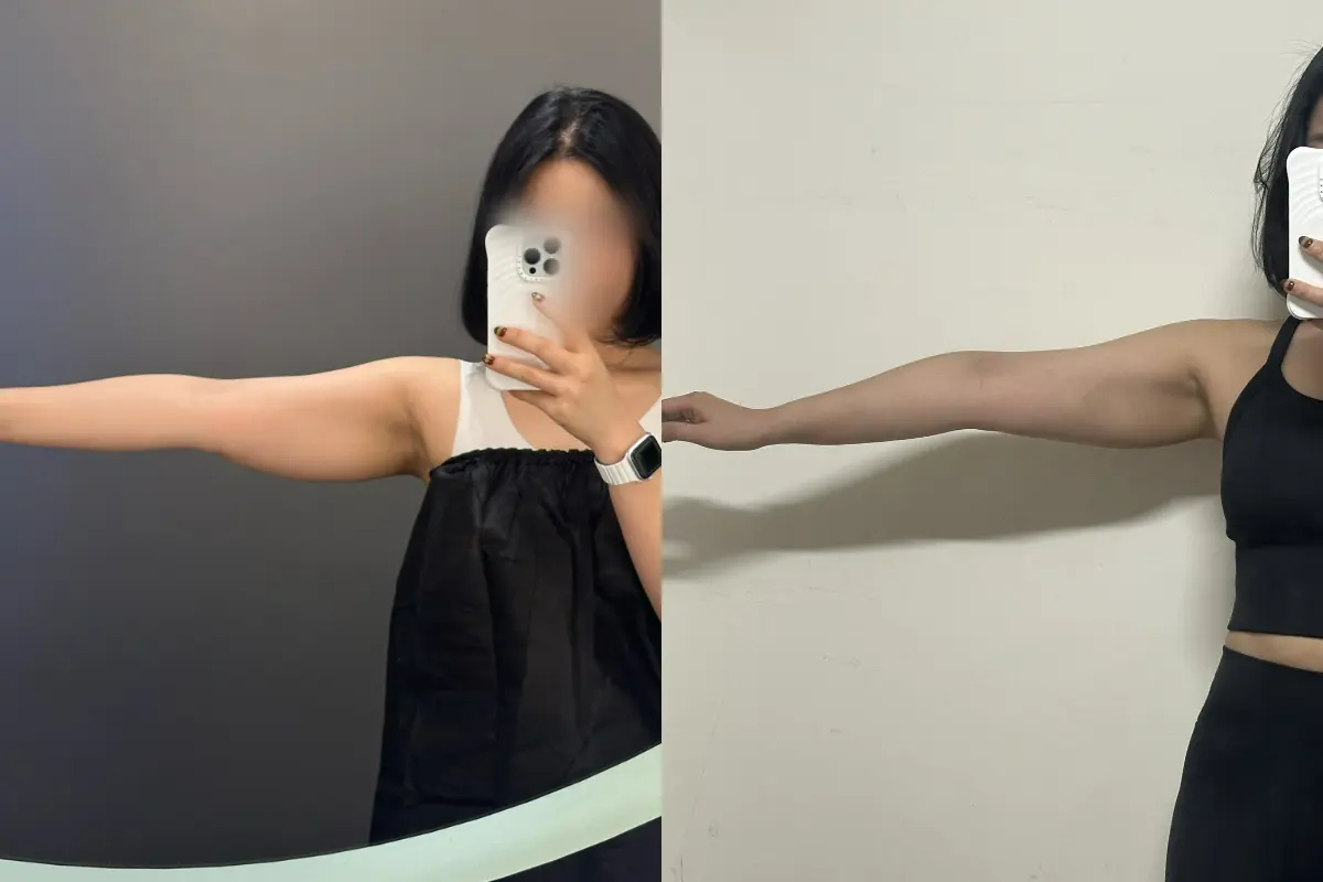 PLAN;S CLINIC 溶脂針效果 江南醫美 江南醫美診所介紹 江南皮膚科