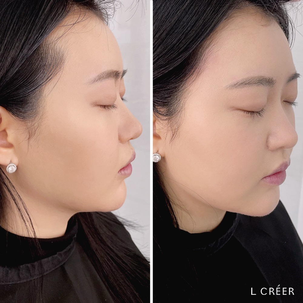 헤어 라인 트리밍 전후, L Créer의 헤어 라인 관리.