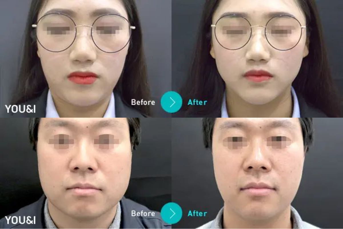 Myeongdong medical aesthetics clinic recommendation
Myeongdong medical aesthetics
Seoul medical aesthetics
Medical aesthetics clinic
Beauty center
Korean medical aesthetic treatments
Myeongdong dermatology
Myeongdong minimally invasive procedures
Korean medical aesthetics prices
Recommended services
Reviews
Address
Skincare
Production line
Non-production line