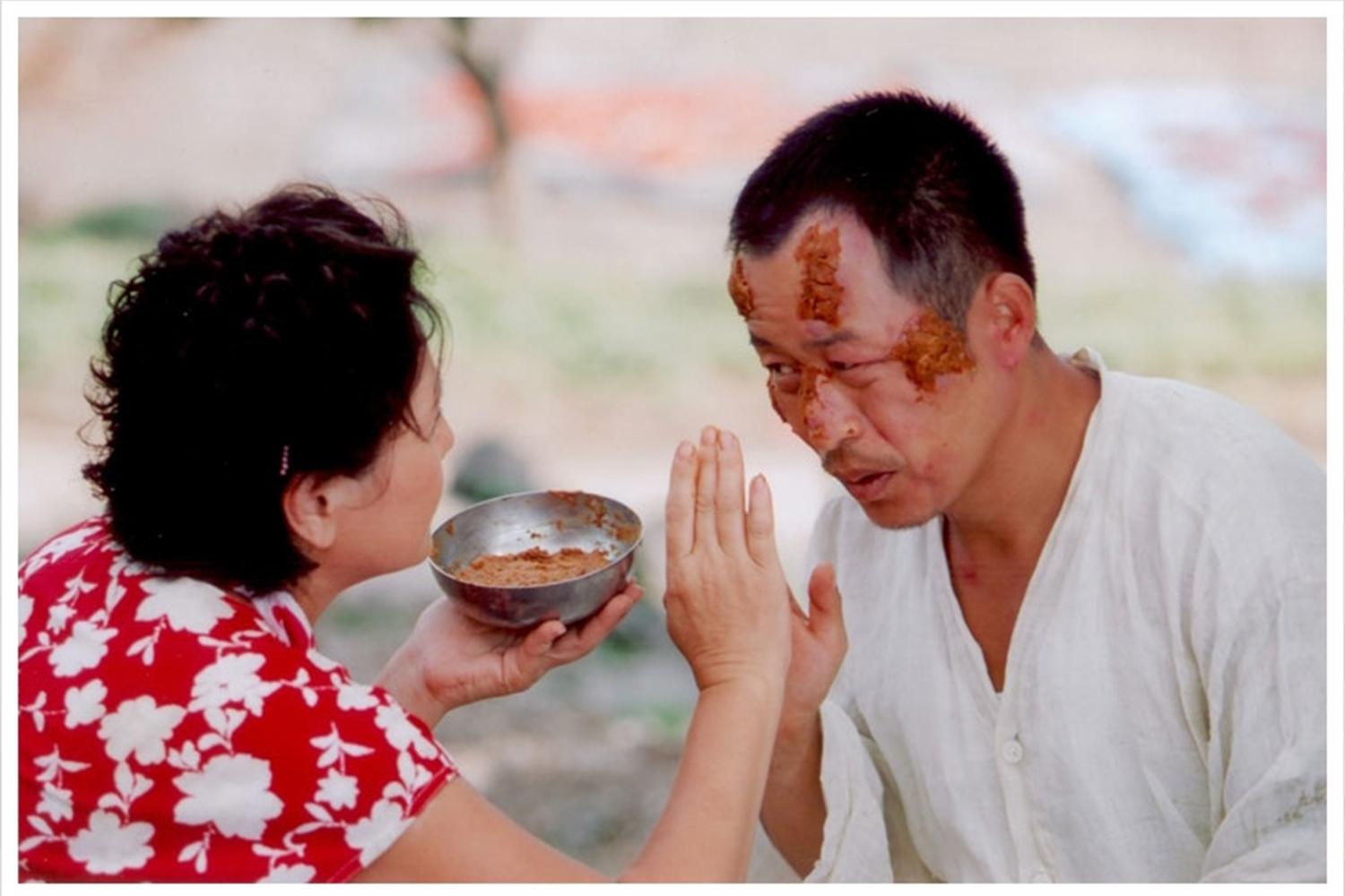 ทเวนจัง แผลผึ้งต่อย