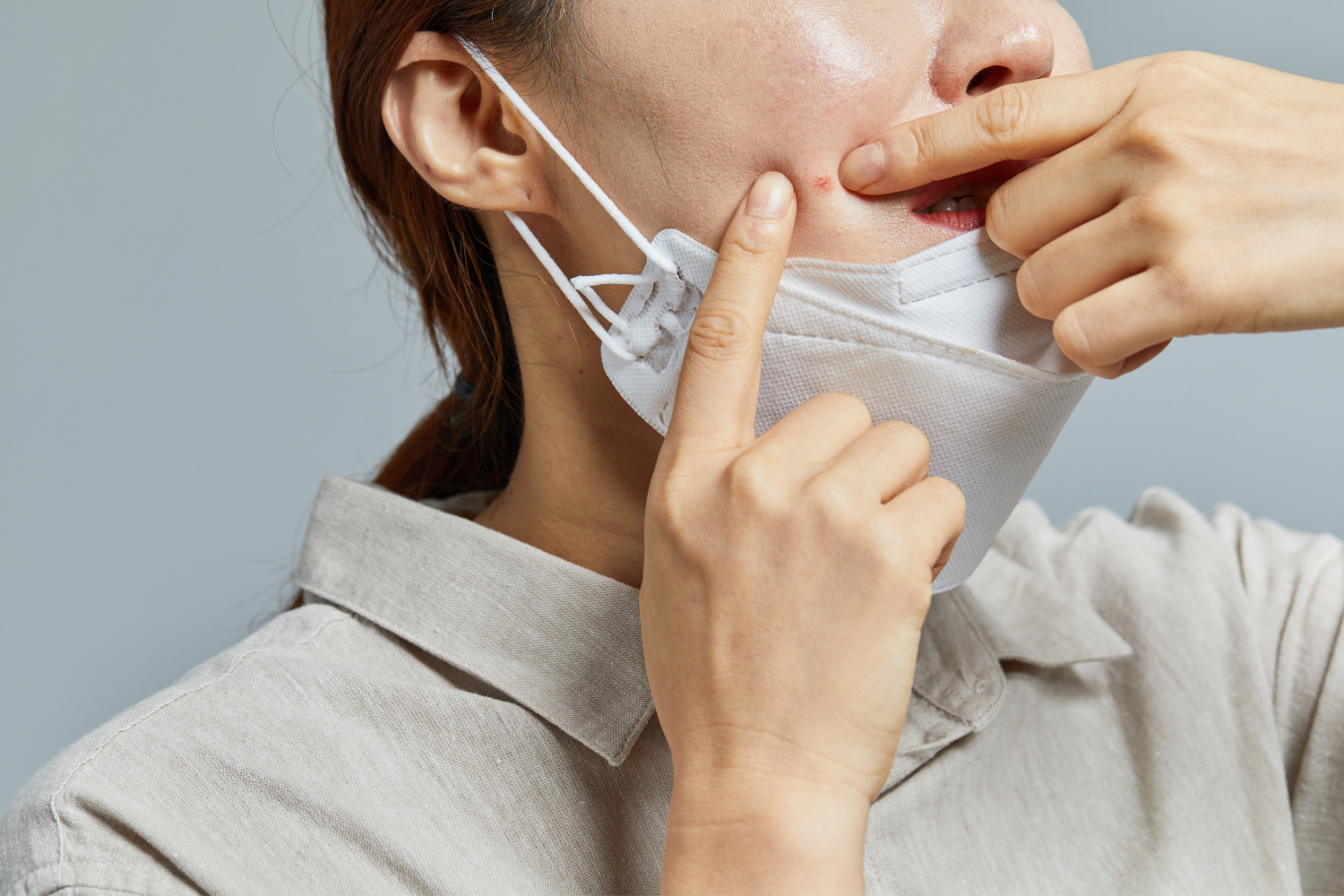 การกำจัดสิวบนใบหน้า