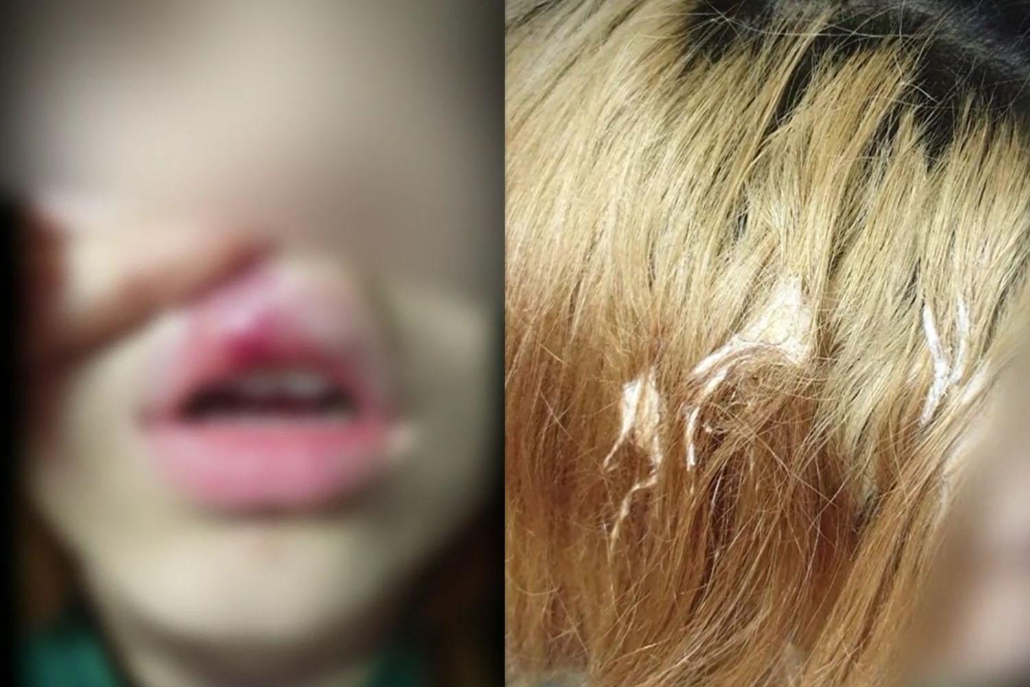 รูปภาพแสดงเด็กหญิงอายุ 15 ปีที่มีร่องรอยบาดแผลบนใบหน้าและแขนขา เนื่องจากความรุนแรงจากเพื่อนร่วมวัยในเมืองอัลซาน ประเทศเกาหลีเกี่ยวกับสถานะครอบครัวหลากหลายวัฒนธรรมของเธอ.