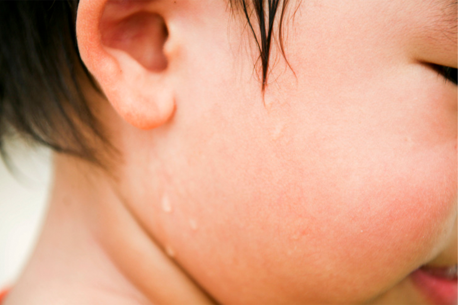 韓國小孩耳朵及周邊皮膚近攝圖像，展示韓國人乾耳朵特徵。
