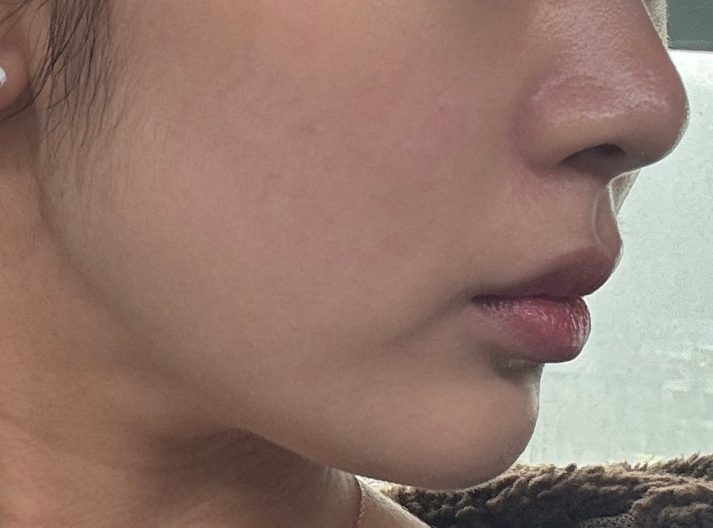 Before Volnewmer Treatment