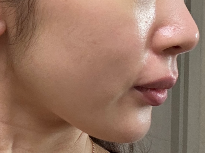 After Volnewmer Treatment