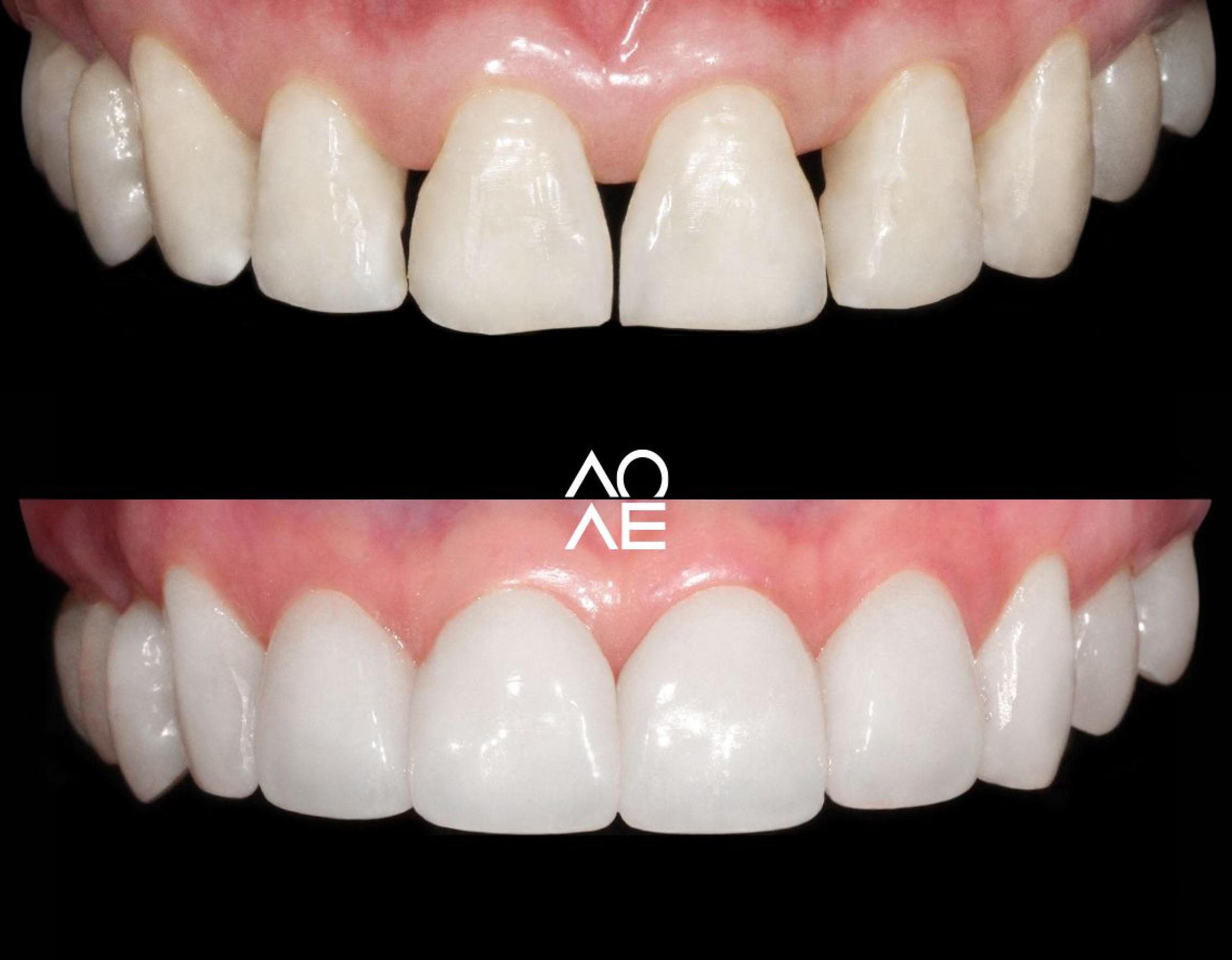 Seoul Centum before-and-after laminate close-up showing natural teeth with gaps above and uniform bright veneers below