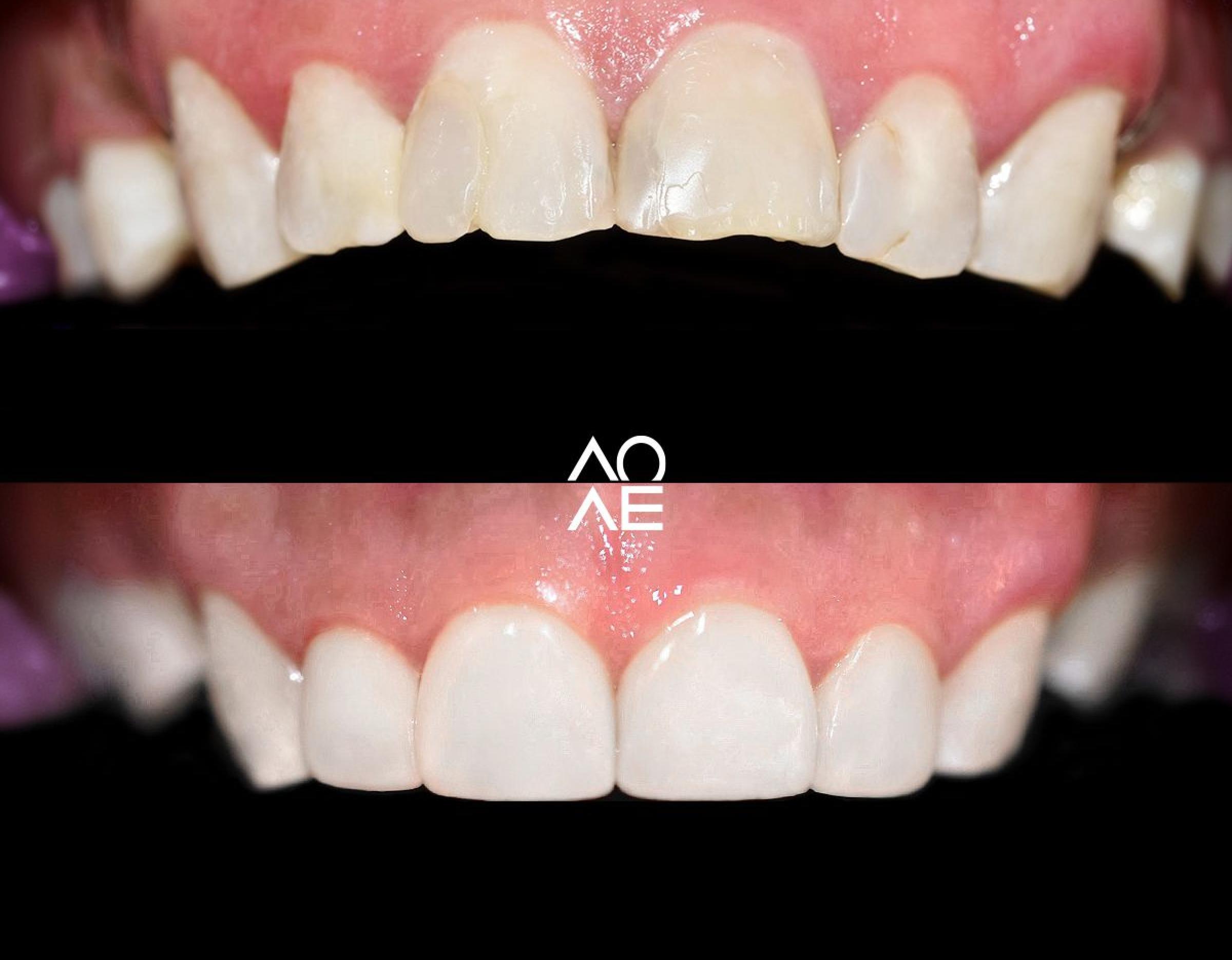 Before-and-after close-up of upper front teeth showing chipped, stained teeth transformed to even, white laminated veneers.