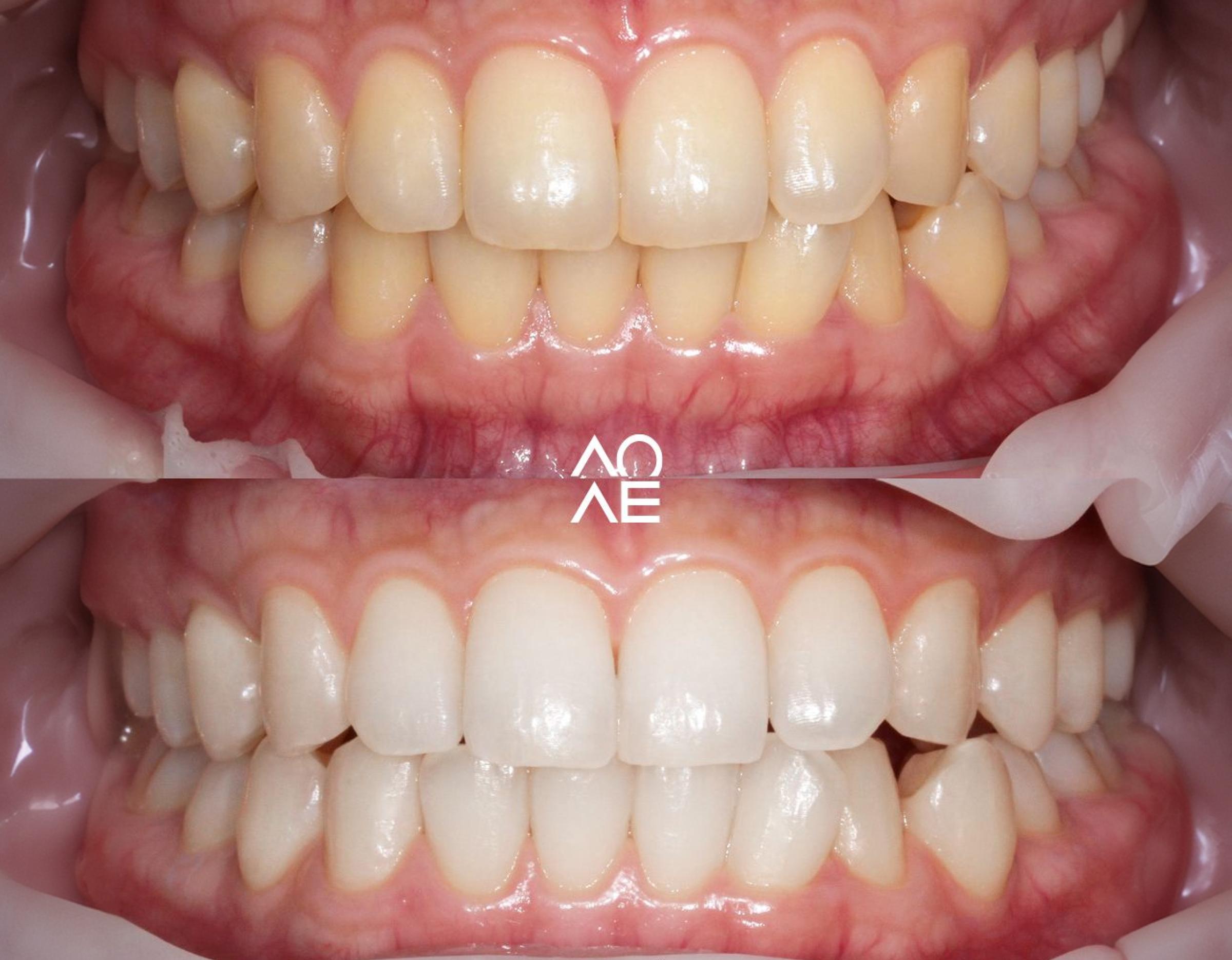 Before-and-after close-up of teeth showing yellowed upper image and brighter, whiter teeth after whitening/laminate treatment.
