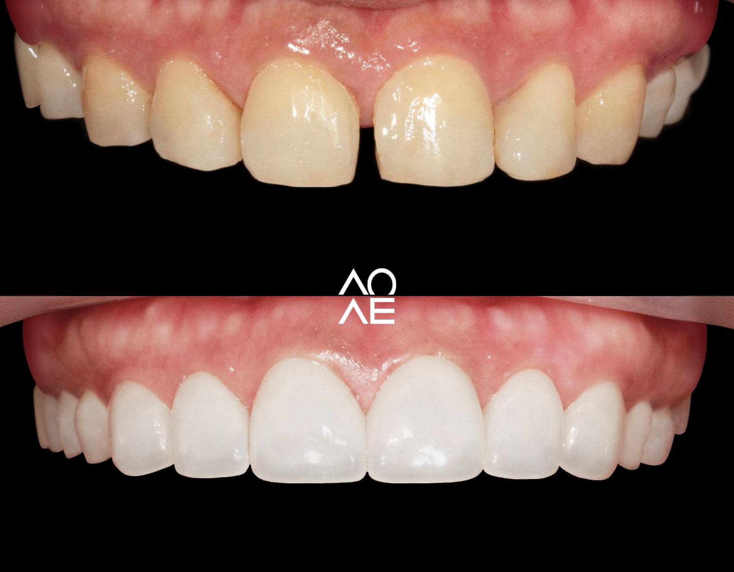 Seam-side comparison of upper front teeth before and after laminate treatment showing straighter, whiter veneers and healthier gums