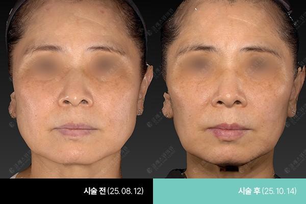 Class One Clinic шанаа Botox өмнө ба дараах зураг
