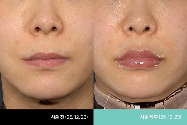 Class One Clinic уруул Filler өмнө ба дараах зураг