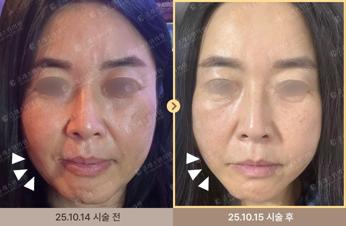 Class One Clinic thread lifting өмнө ба дараах зураг