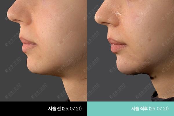 Class One Clinic шанаа Filler өмнө ба дараах зураг