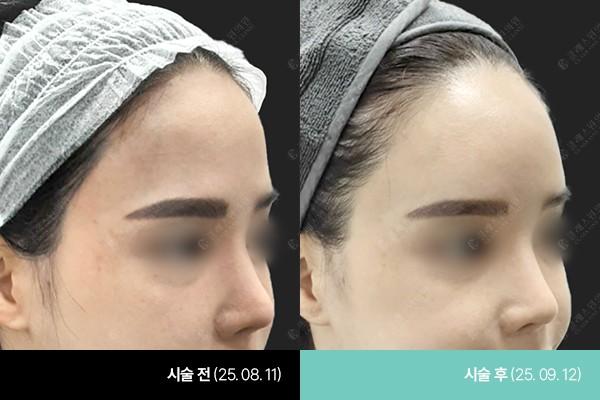 Class One Clinic нурууны хэсэг Filler өмнө ба дараах зураг