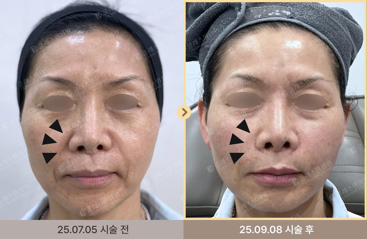 Class One Clinic носогийн нүдний доорх Filler өмнө ба дараах зураг