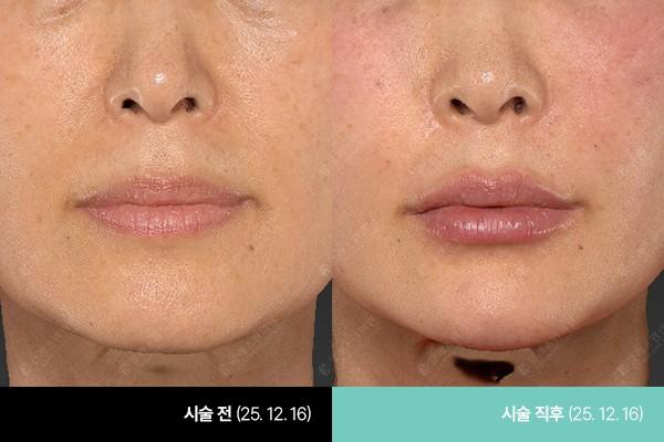 Class One Clinic уруул Filler өмнө ба дараах зураг