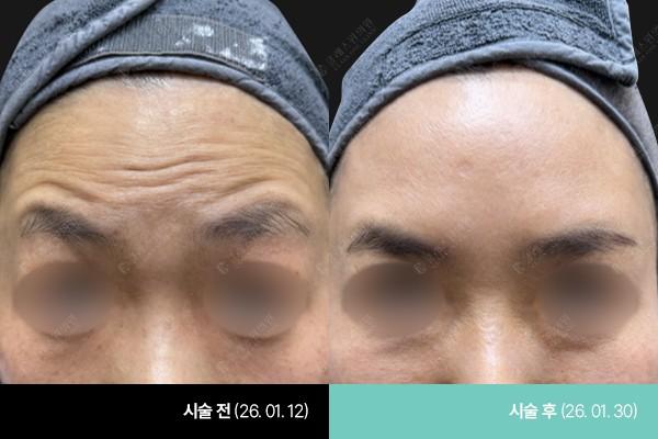 Class One Clinic дээлийн үрчлээ Botox өмнө ба дараах зураг