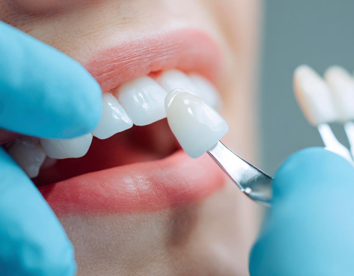 dentist wearing blue gloves holding a porcelain veneer against a patient's upper front tooth for shade matching