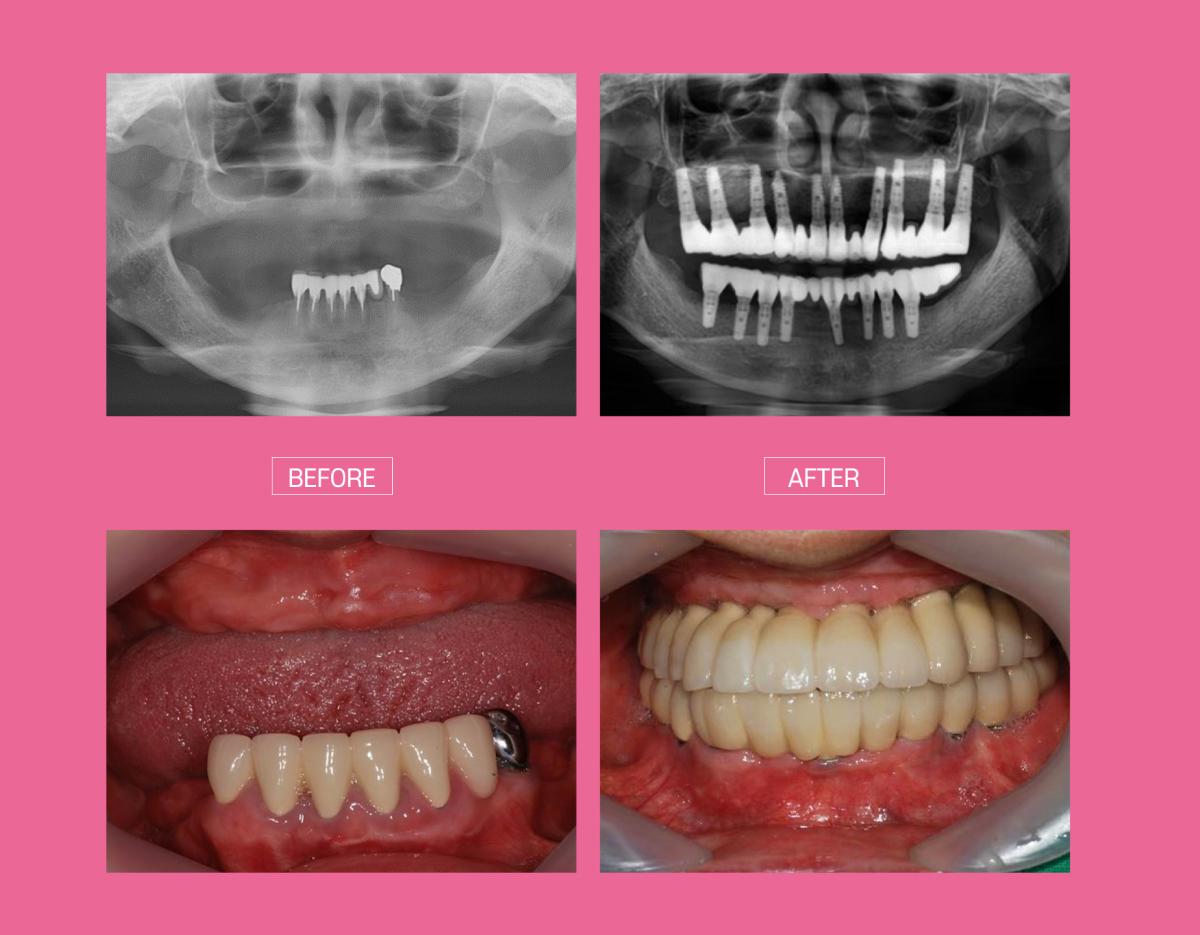 split comparison showing dental X-rays and intraoral before-and-after photos of full lower jaw implant restoration at clinic