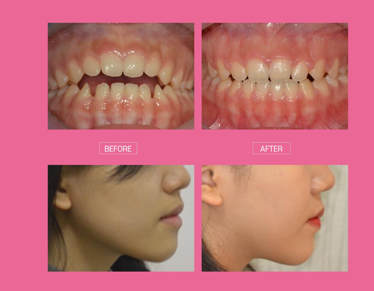 before-and-after close-up of upper front teeth and gums with pink background, plus blurred side profile sections of a patient's jaw and ear