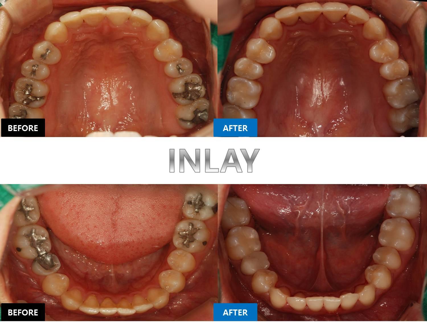 GOODWILL Dental Hospital before-and-after inlay results showing replaced silver fillings with tooth-colored inlays on upper and lower molars