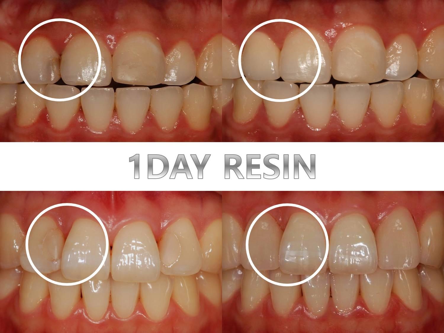GOODWILL DENTAL HOSPITAL before-and-after close-up showing 1-day resin tooth repair on upper front tooth circled, teeth and gums visible